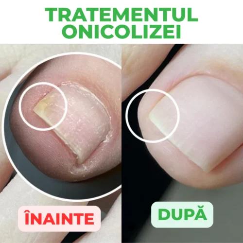 Solutie tratament pentru unghii si piele, 30ml